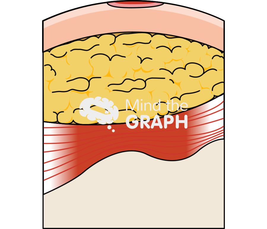 Ulcer formation 1 Icons, Symbols, Pictures, and Images