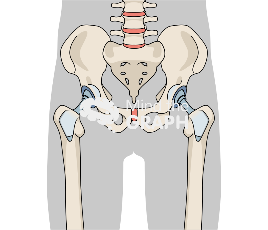 Ultra short total hip arthroplasty body Icons, Symbols, Pictures, and Images