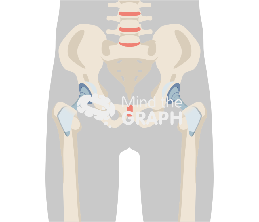 Ultra short total hip arthroplasty body Icons, Symbols, Pictures, and Images
