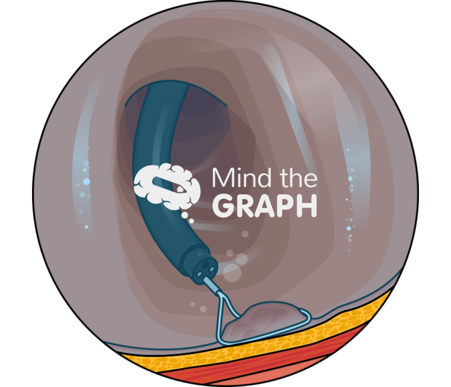 Underwater endoscopic mucosal resection uemr zoom Icons, Symbols, Pictures, and Images