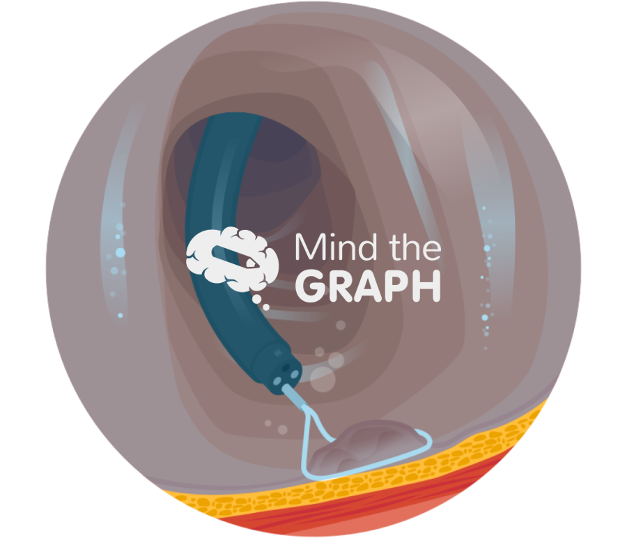 Underwater endoscopic mucosal resection uemr zoom Icons, Symbols, Pictures, and Images