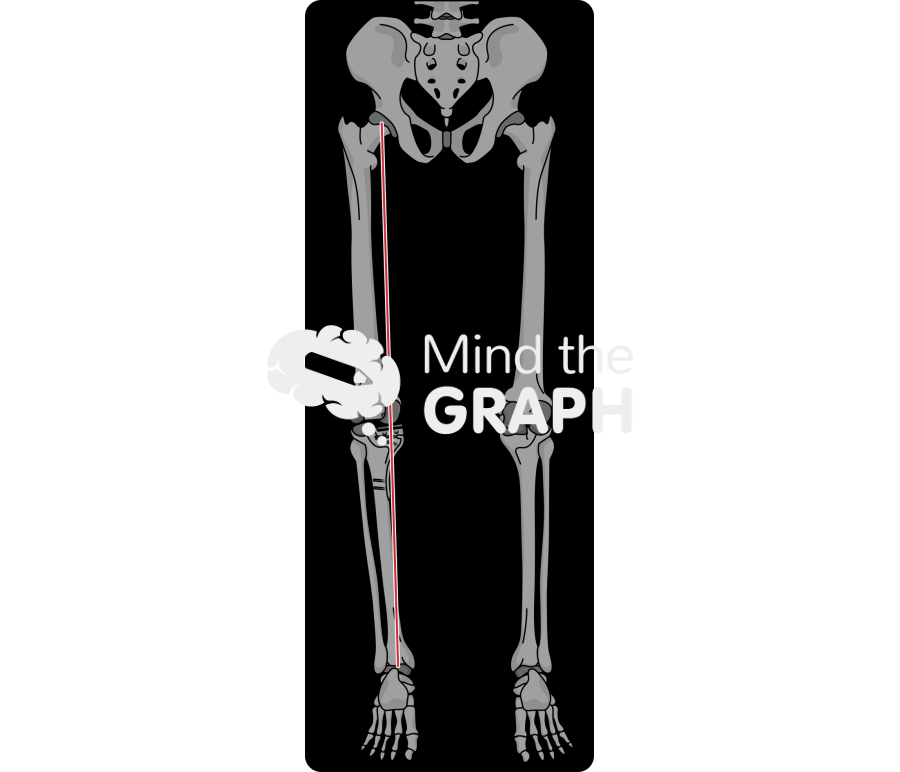 Unicompartment knee arthroplasty high tibial osteotomy alignment x ray Icons, Symbols, Pictures, and Images