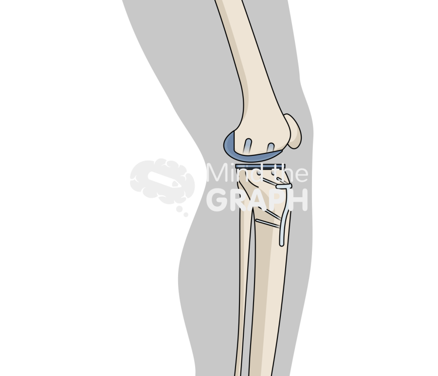 Unicompartmental knee arthroplasty high tibial osteotomy lateral body Icons, Symbols, Pictures, and Images