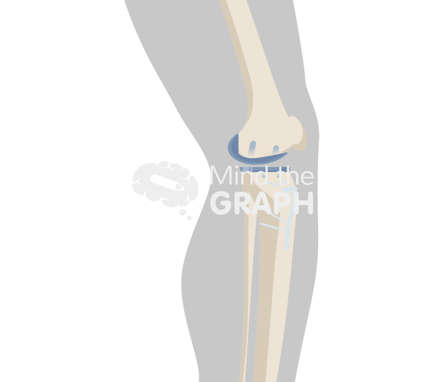 Unicompartmental knee arthroplasty high tibial osteotomy lateral body Icons, Symbols, Pictures, and Images