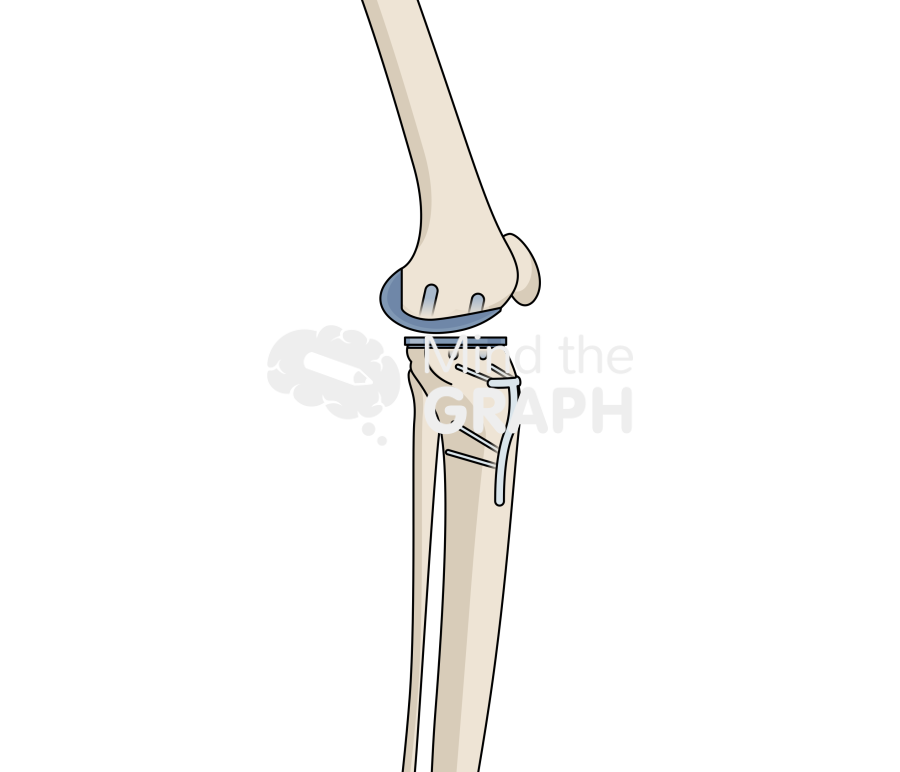 Unicompartmental knee arthroplasty high tibial osteotomy lateral bone full Icons, Symbols, Pictures, and Images