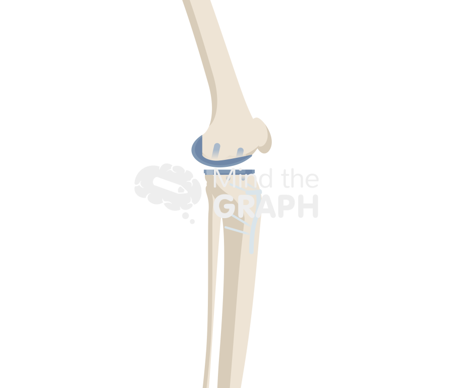 Unicompartmental knee arthroplasty high tibial osteotomy lateral bone full Icons, Symbols, Pictures, and Images