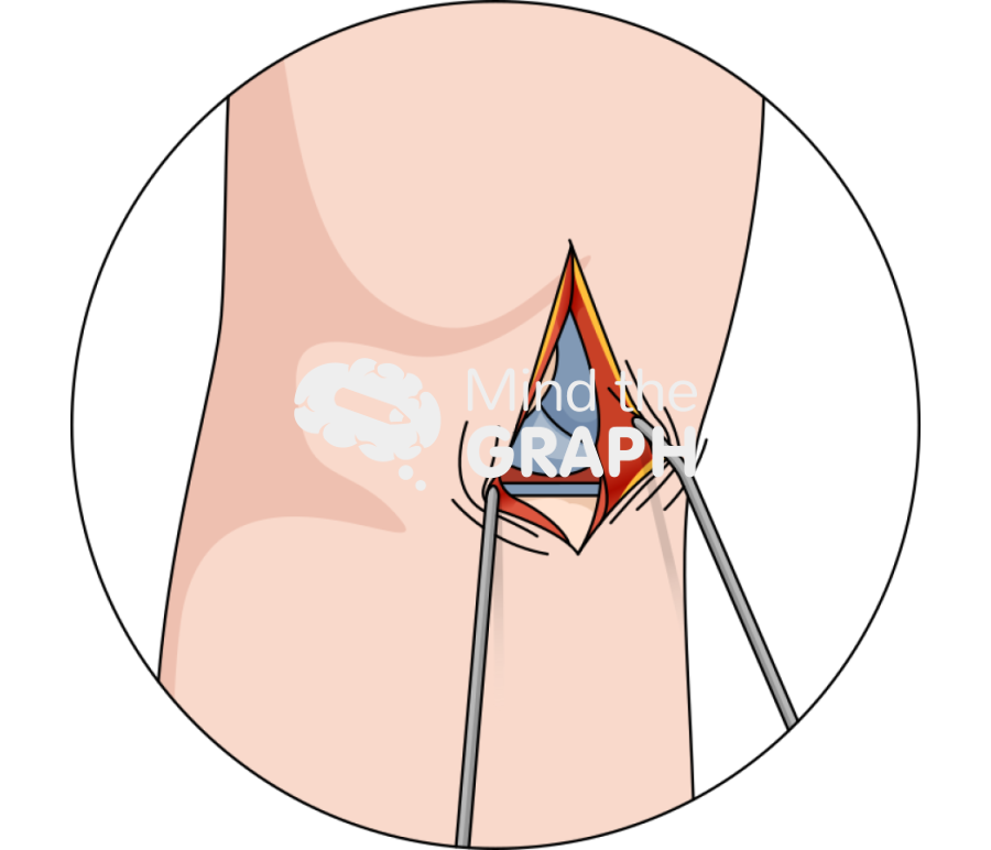 Unicondylar knee arthroplasty deep implants body zoom Icons, Symbols, Pictures, and Images