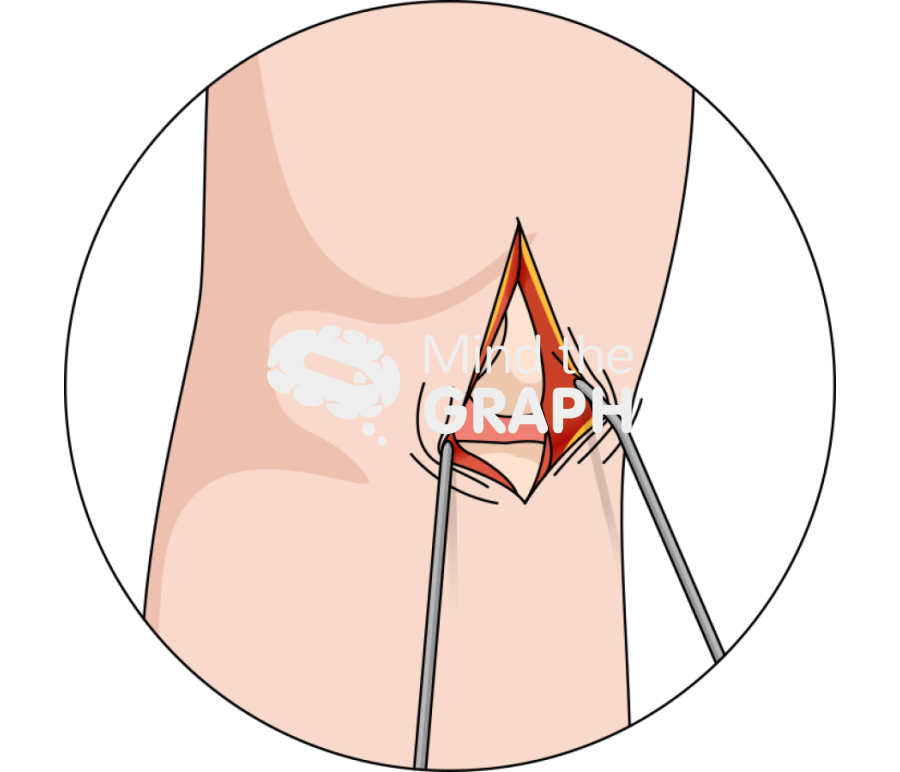 Unicondylar knee arthroplasty deep incision body zoom Icons, Symbols, Pictures, and Images