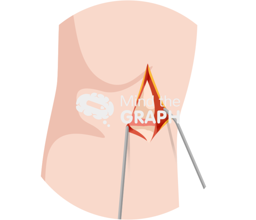 Unicondylar knee arthroplasty deep incision body zoom Icons, Symbols, Pictures, and Images