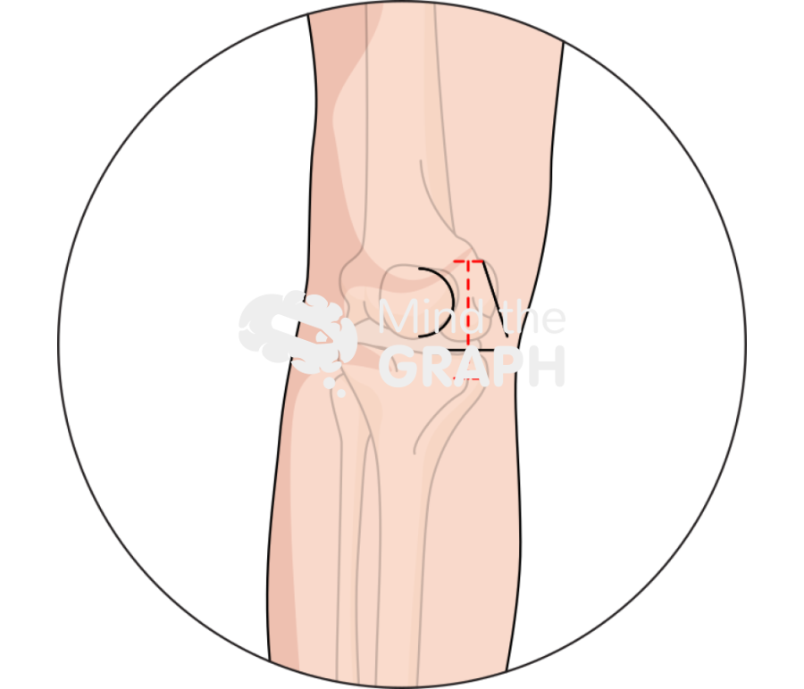 Unicondylar knee arthroplasty skin incision zoom Icons, Symbols, Pictures, and Images