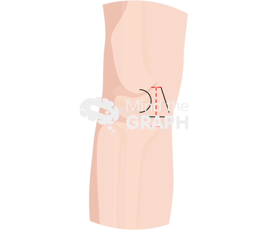 Unicondylar knee arthroplasty skin incision zoom Icons, Symbols, Pictures, and Images