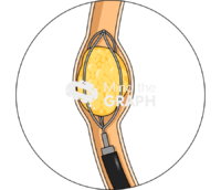 Ureteroscopy procedure zoom - Edit and Customize Icons of Ureteroscopy procedure zoom Ureteroscopy procedure zoom Icons, Symbols, Pictures, and Images