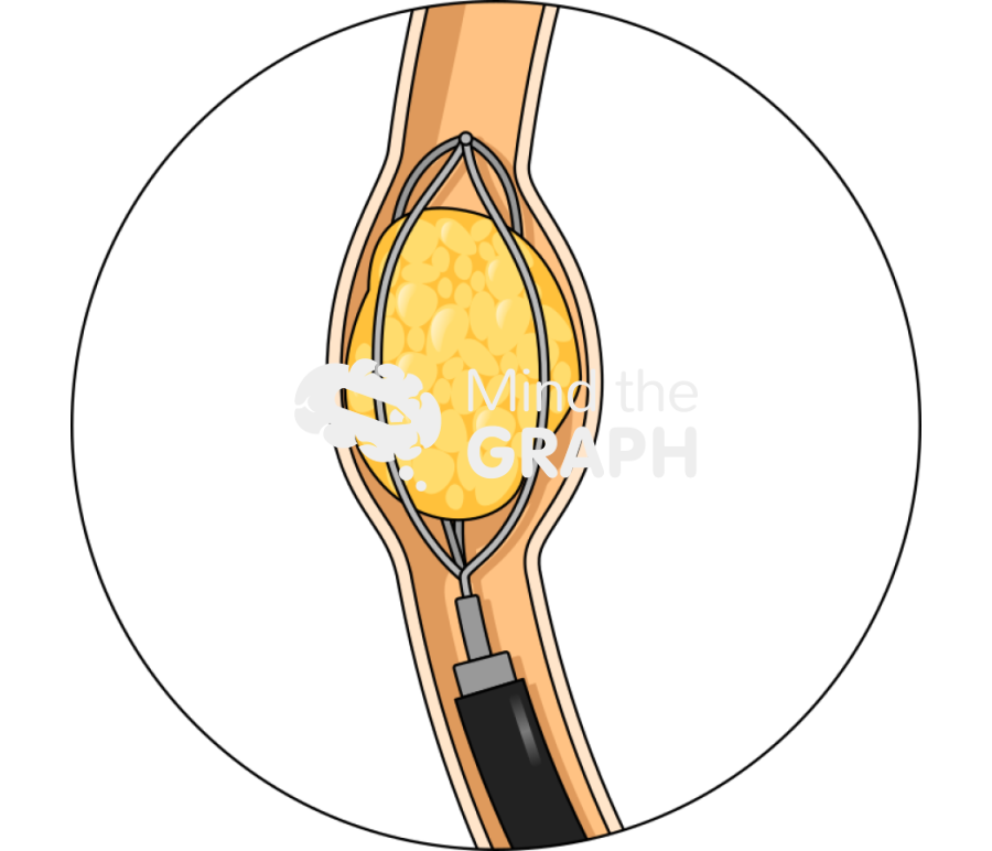 Ureteroscopy procedure zoom Icons, Symbols, Pictures, and Images