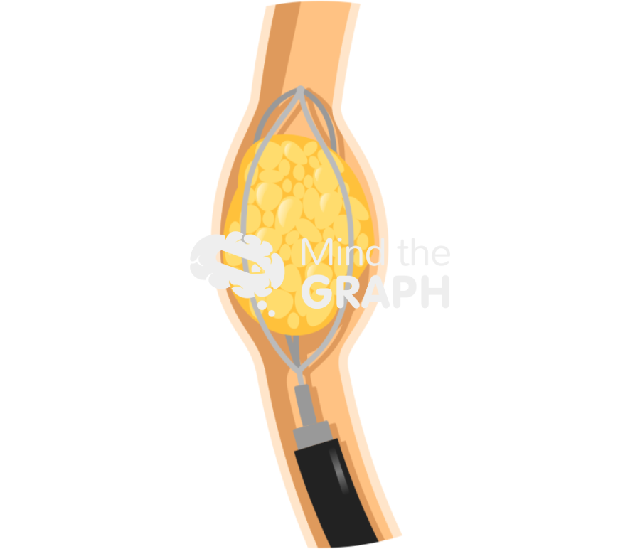 Ureteroscopy procedure zoom Icons, Symbols, Pictures, and Images