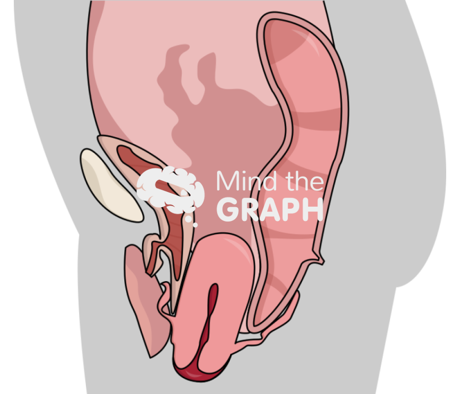 Uterine prolapse 2 Icons, Symbols, Pictures, and Images
