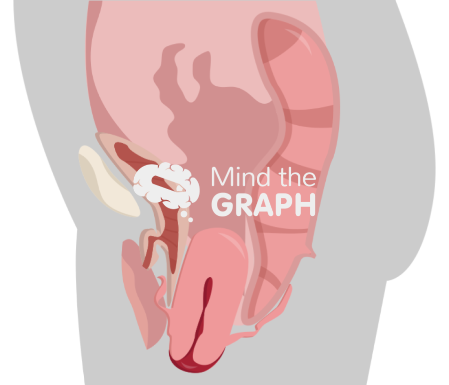 Uterine prolapse 2 Icons, Symbols, Pictures, and Images