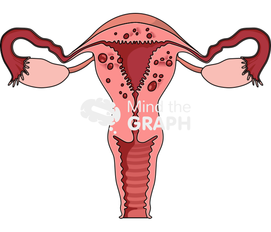 Uterus adenomyosis front cut Icons, Symbols, Pictures, and Images