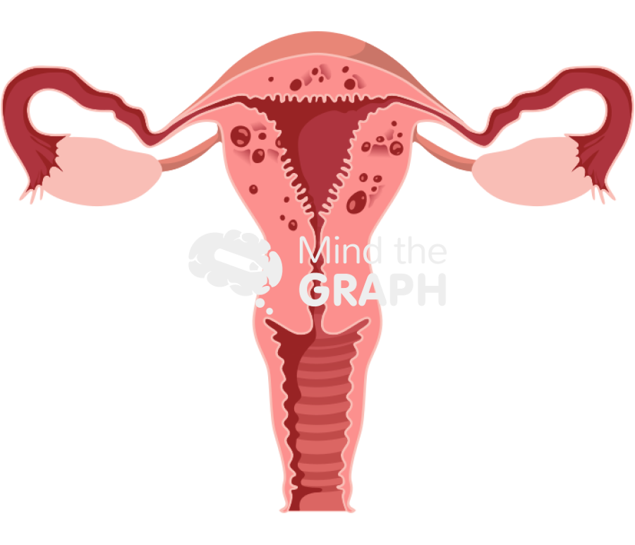 Uterus adenomyosis front cut Icons, Symbols, Pictures, and Images