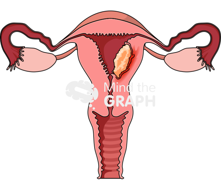 Uterus cancer front cut Icons, Symbols, Pictures, and Images