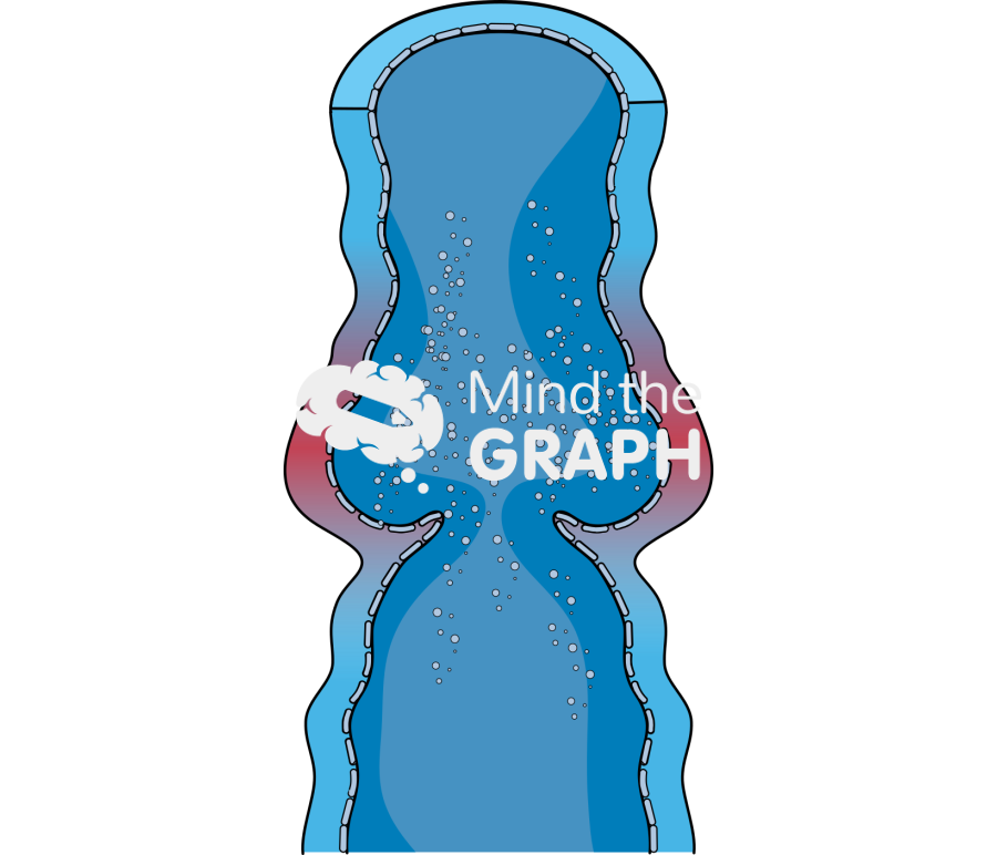 Varicose vein inflamed with incopetent valve Icons, Symbols, Pictures, and Images