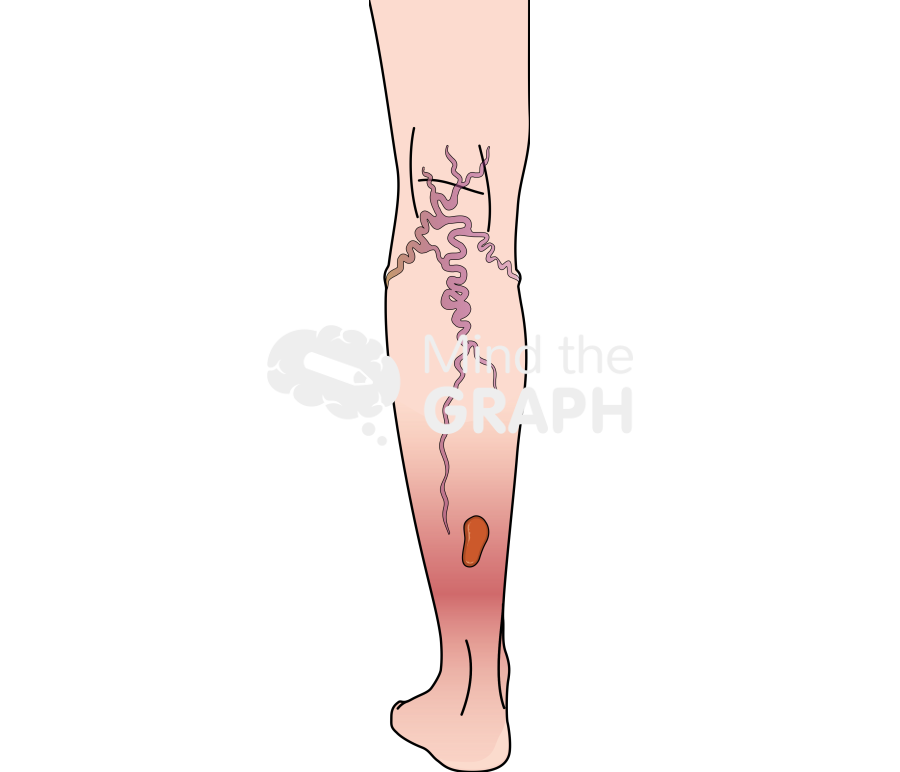 Venous leg ulcer Icons, Symbols, Pictures, and Images