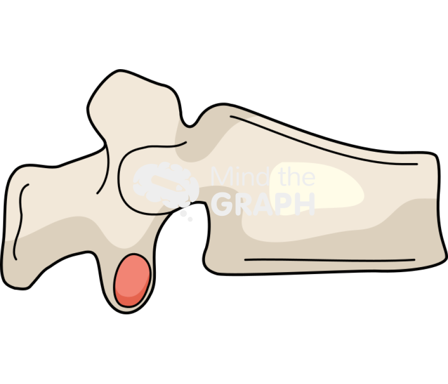 Vertebra fracture 1 Icons, Symbols, Pictures, and Images