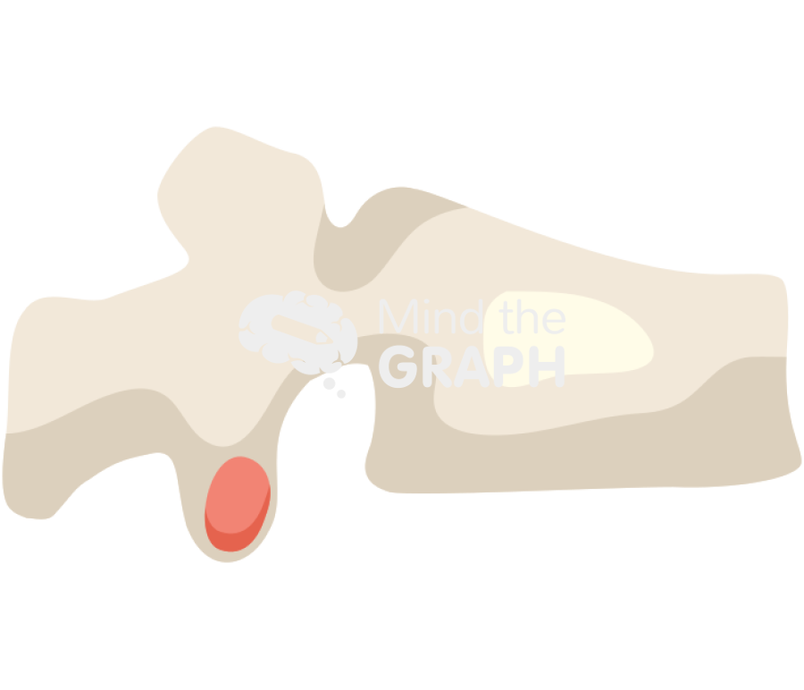 Vertebra fracture 1 Icons, Symbols, Pictures, and Images