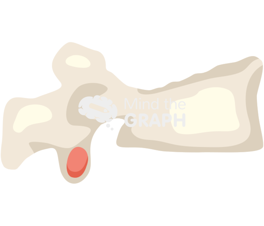 Vertebra fracture 3 Icons, Symbols, Pictures, and Images