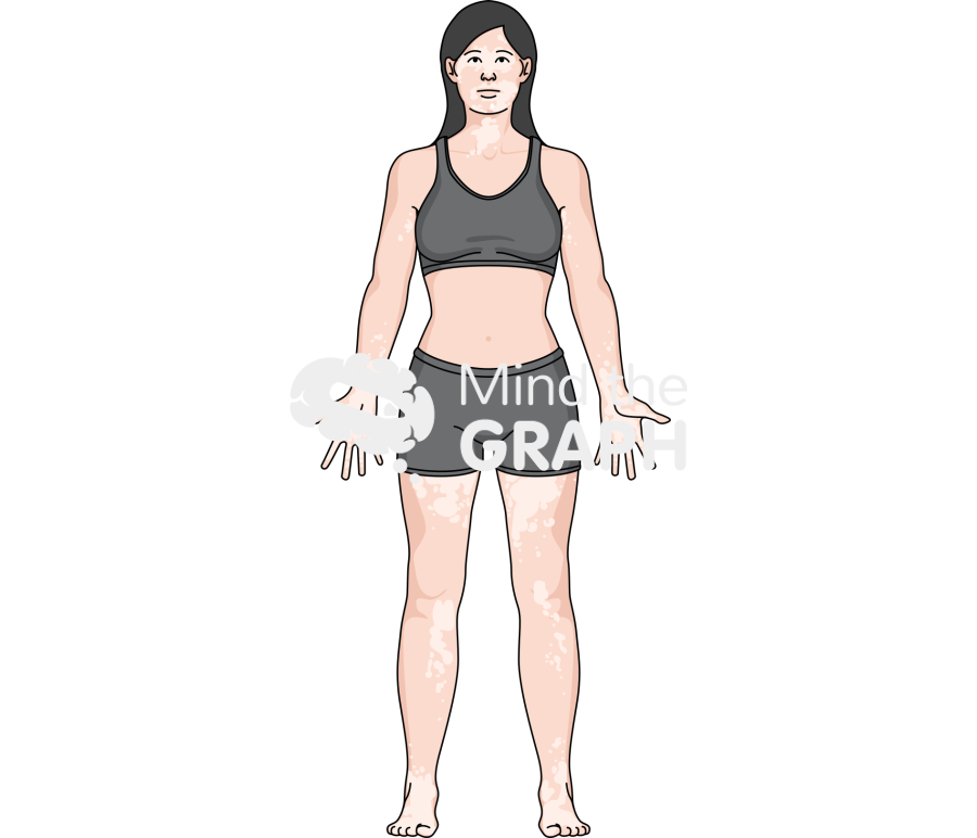 Woman vitiligo shorts caucasian Icons, Symbols, Pictures, and Images