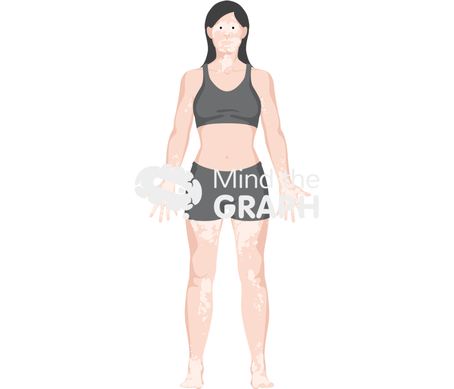 Woman vitiligo shorts caucasian Icons, Symbols, Pictures, and Images