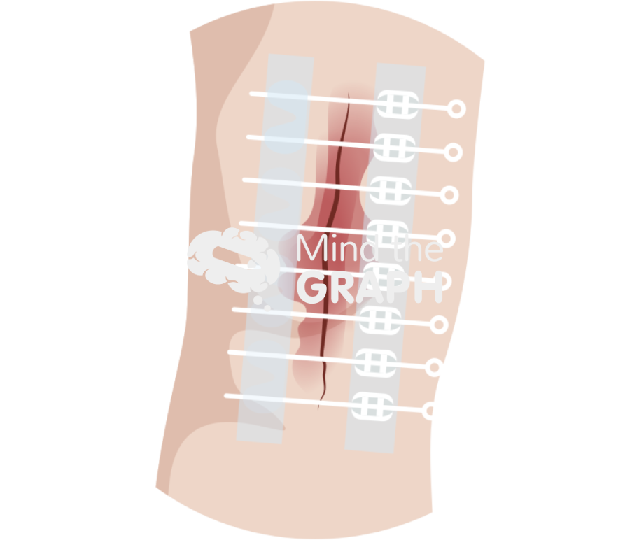 Zipline surgical skin closure Icons, Symbols, Pictures, and Images